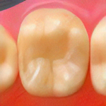 セラミックインレー